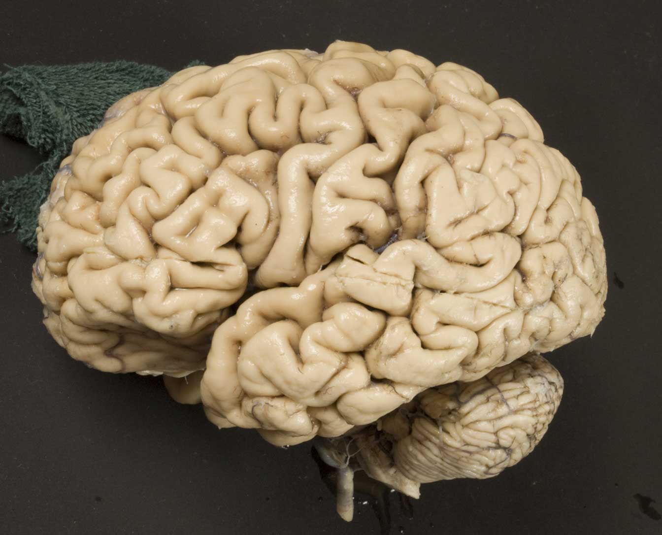 Brain - 2