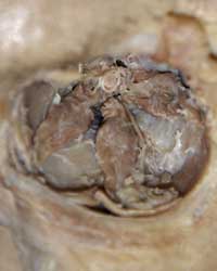 Anterior Orbit - Floor