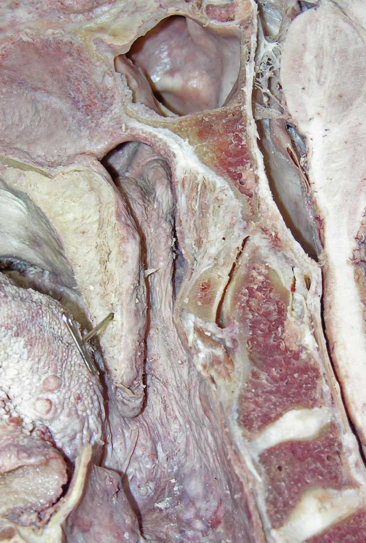 Nasopharynx - 1