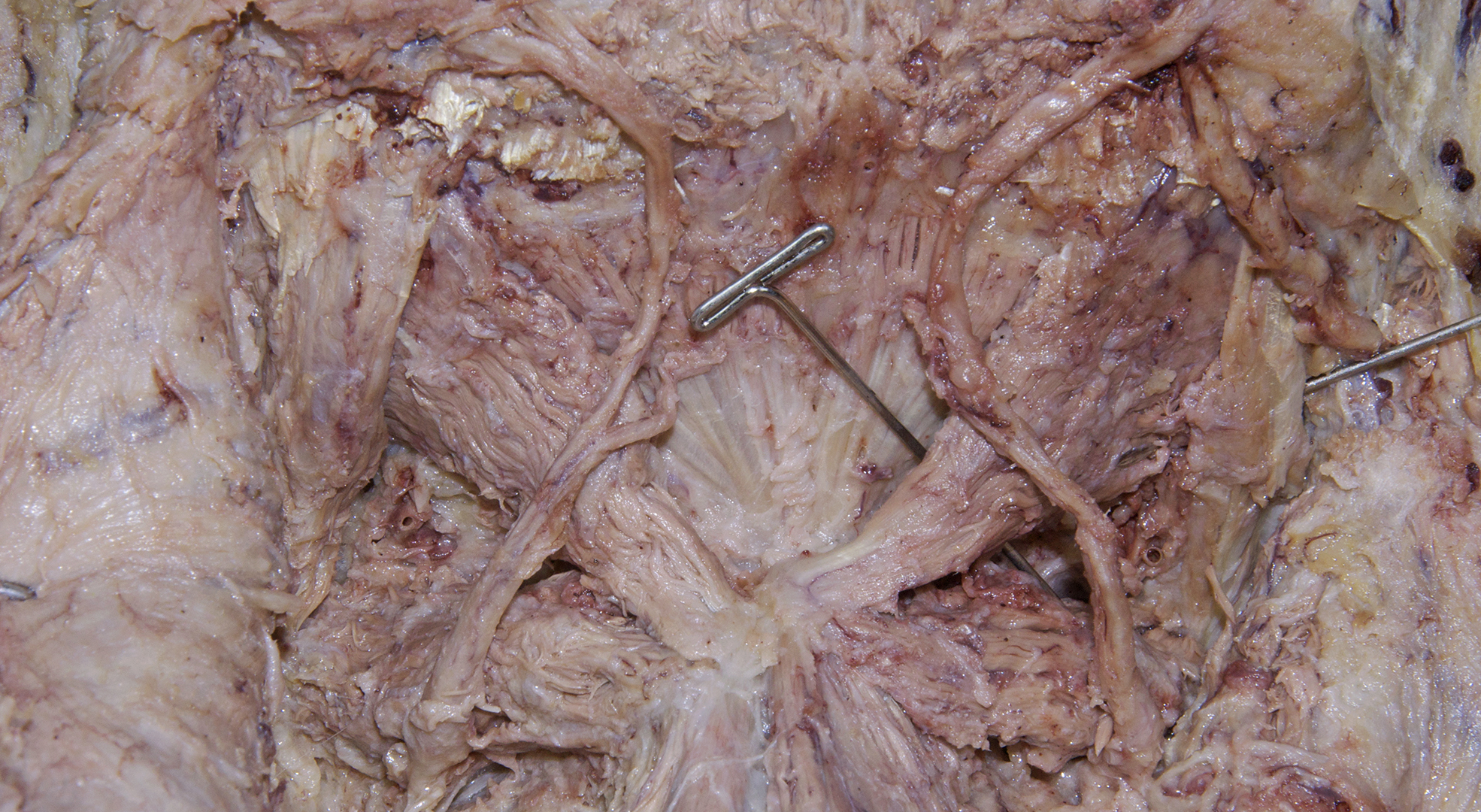 Suboccipital Triangle - 4
