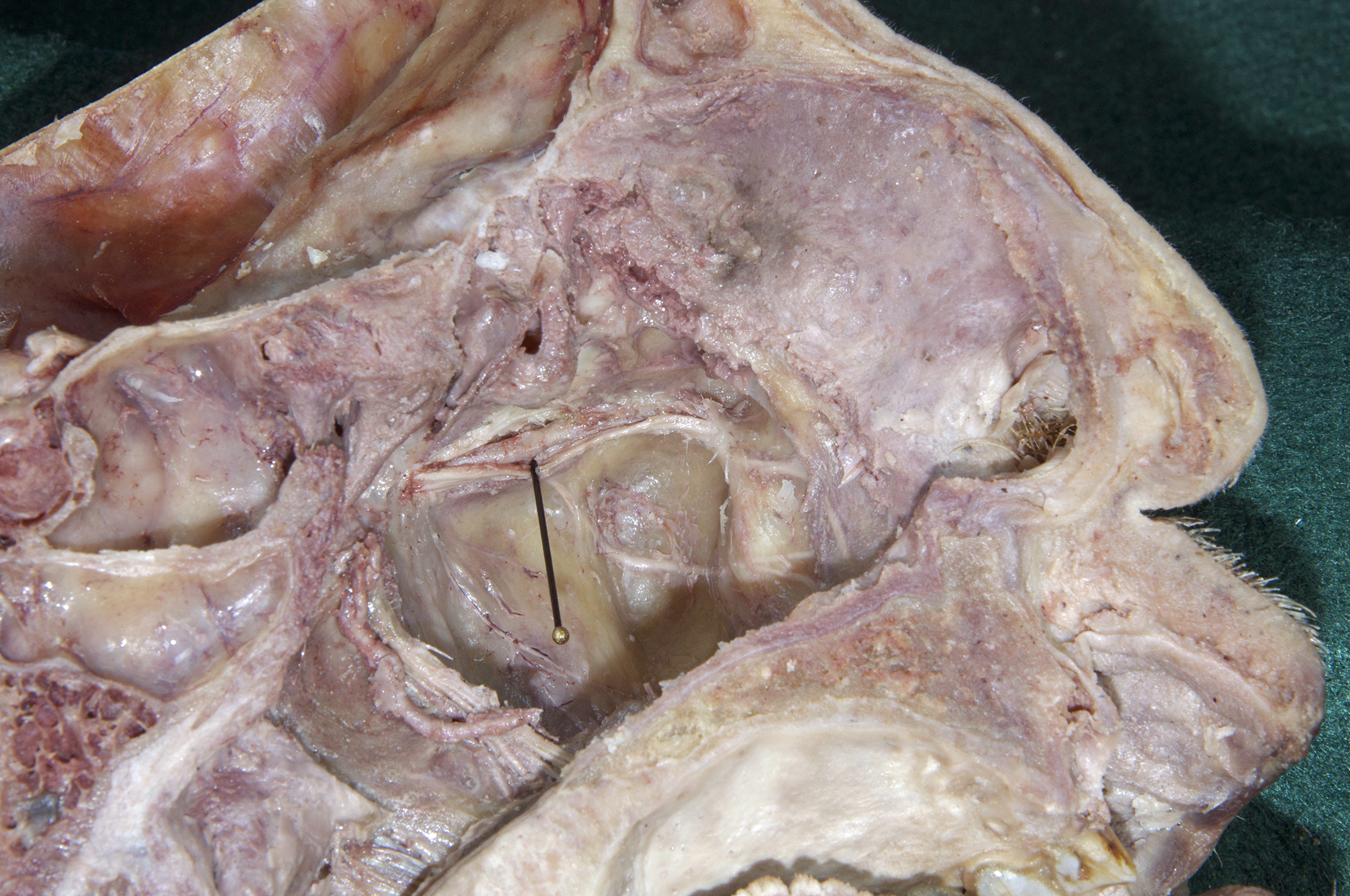 Nasal Cavity - 4