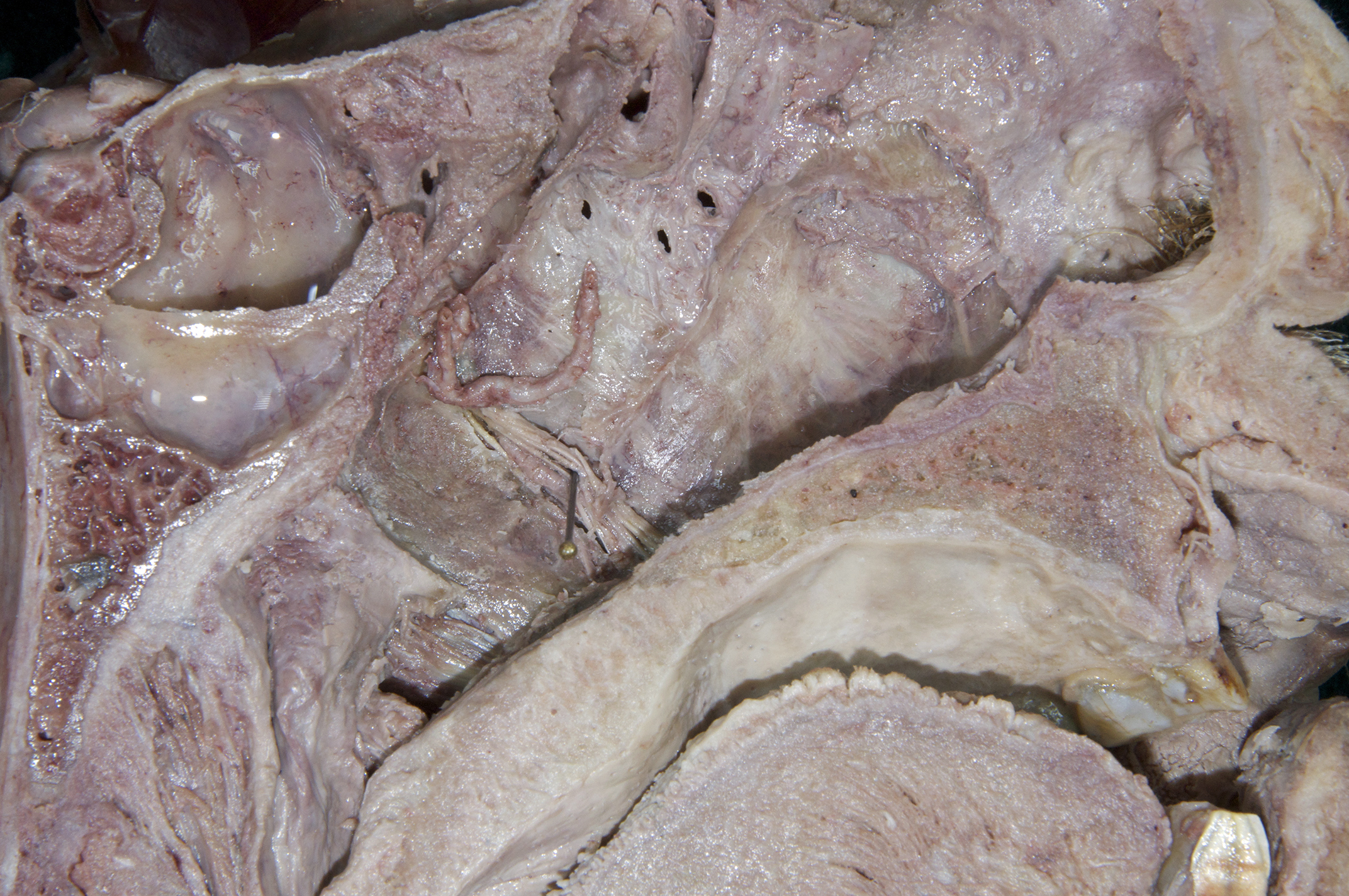 Nasal Cavity - 6