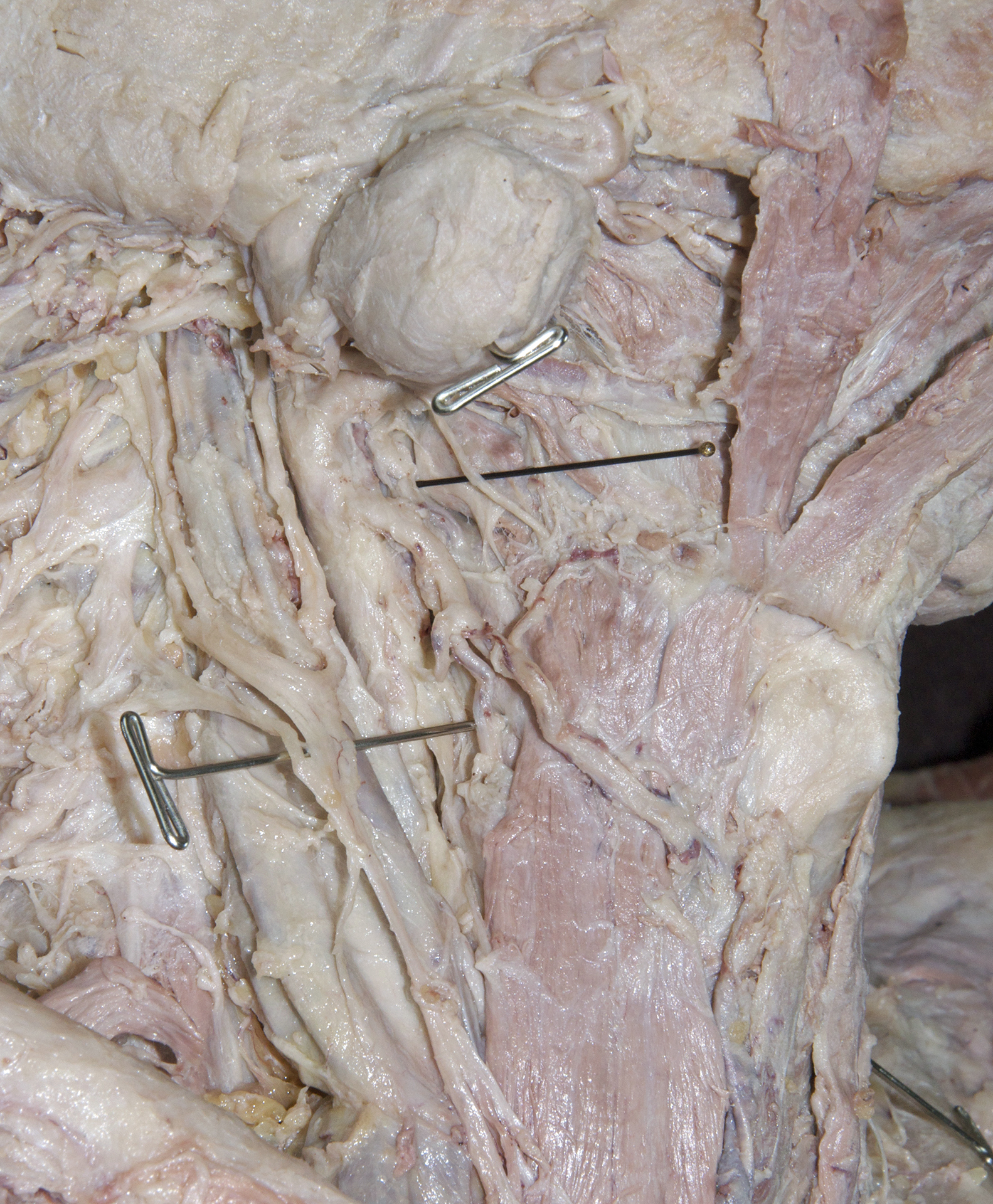 Lateral Neck - 10