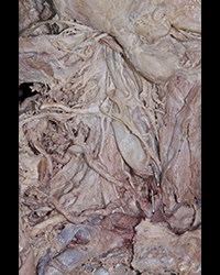 Deep Cervical Lymph Nodes