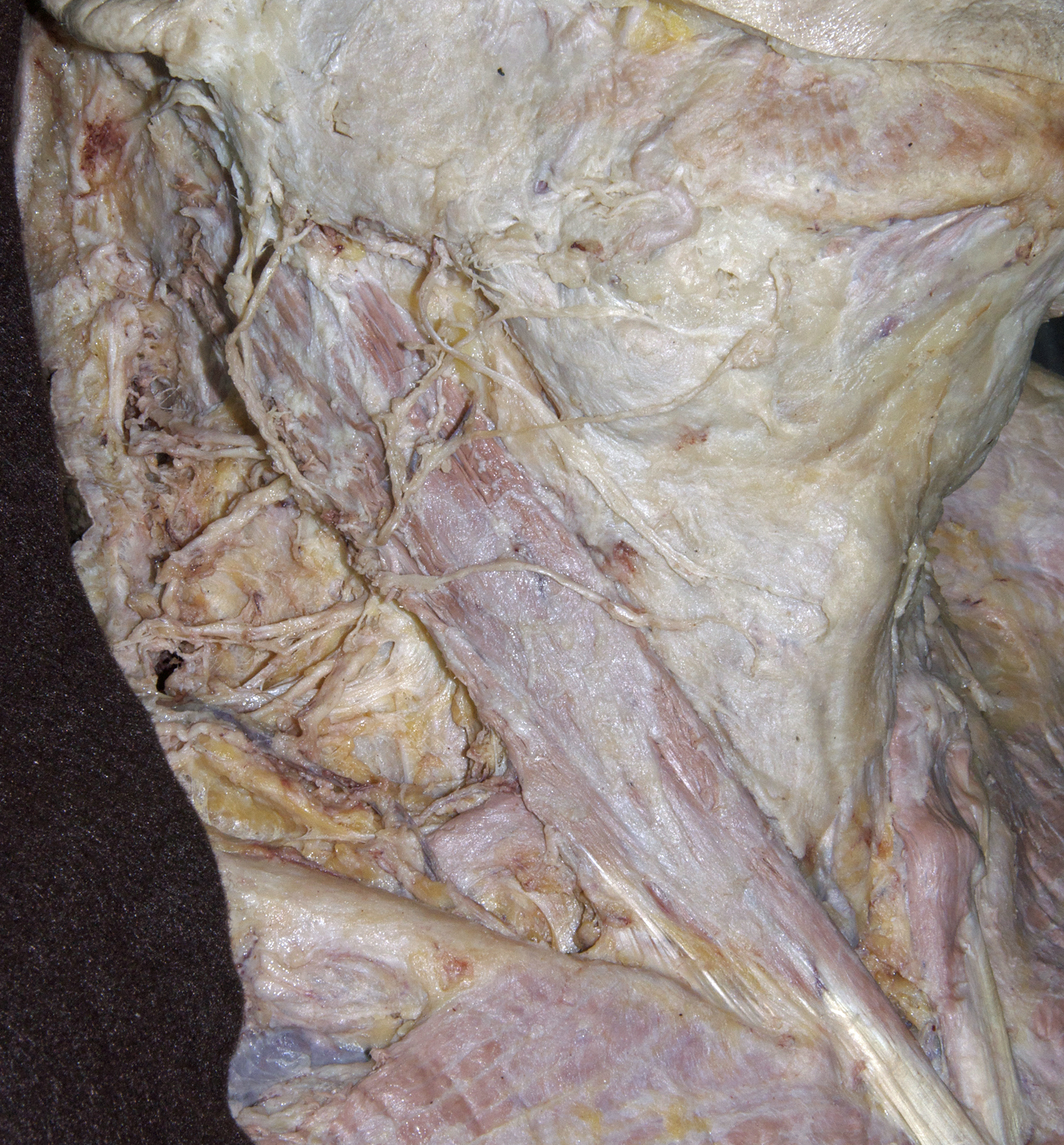 Lateral Neck - 8