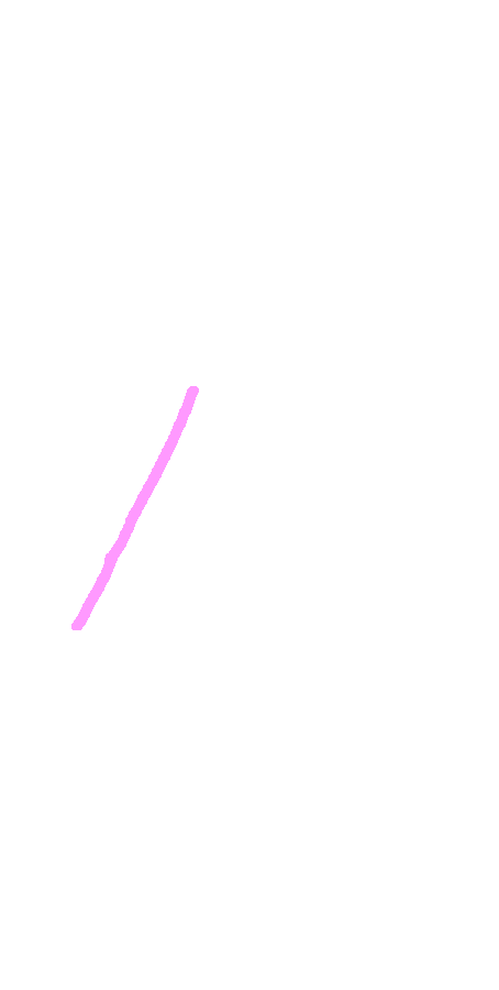 Lateral Supracondylar Ridge