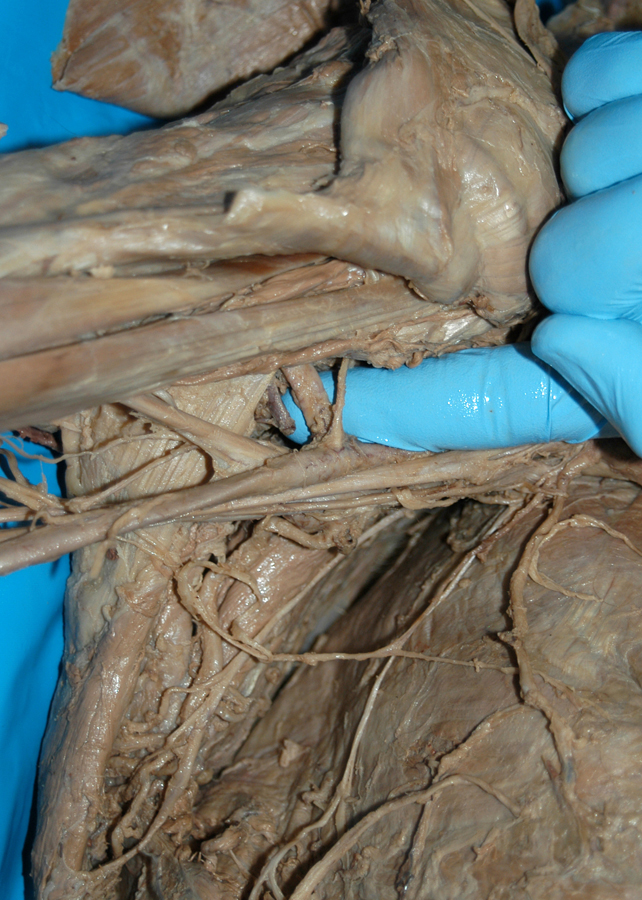 Circumflex Humeral Arteries
