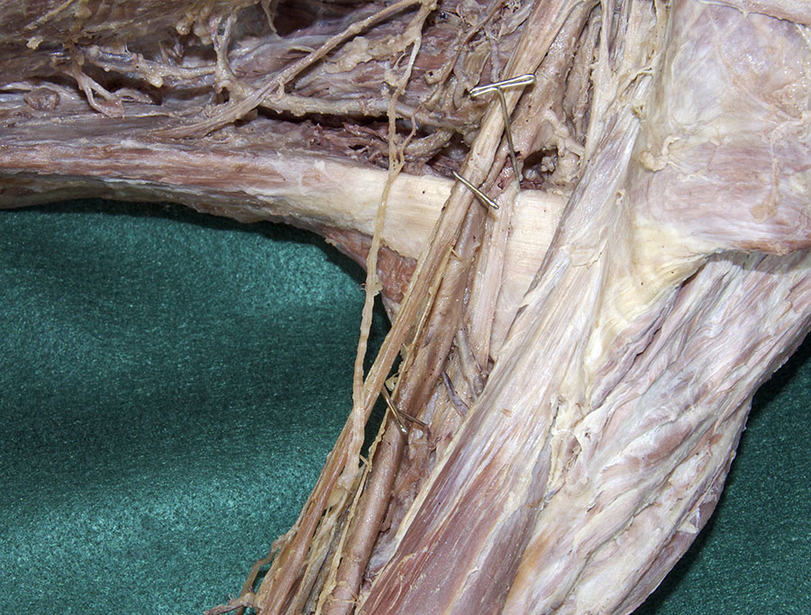 Profunda Brachii Artery