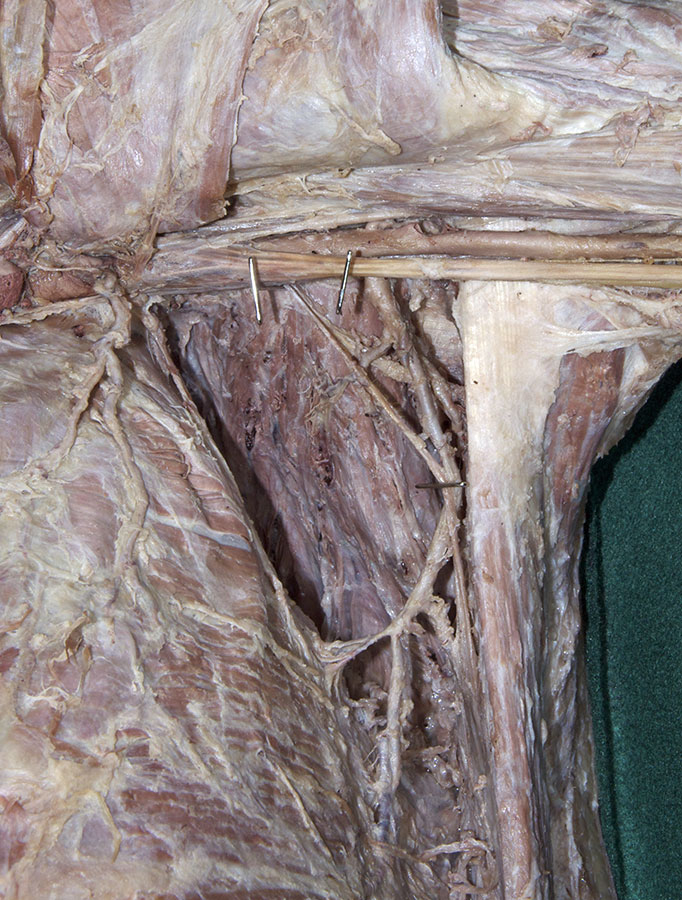 Left Subscapularis Muscle