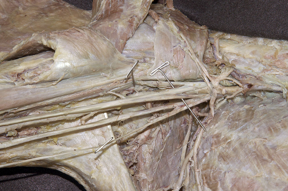 Lateral Root of Median Nerve