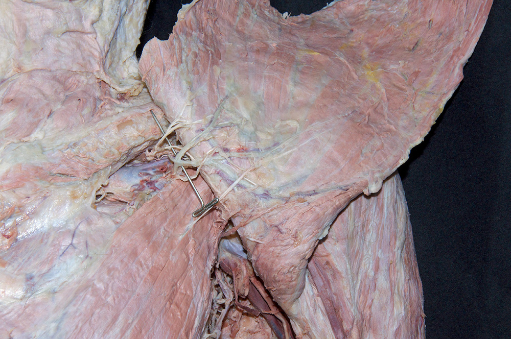 Thoracoacromial Artery