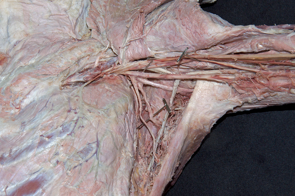 Subscapular Nerves
