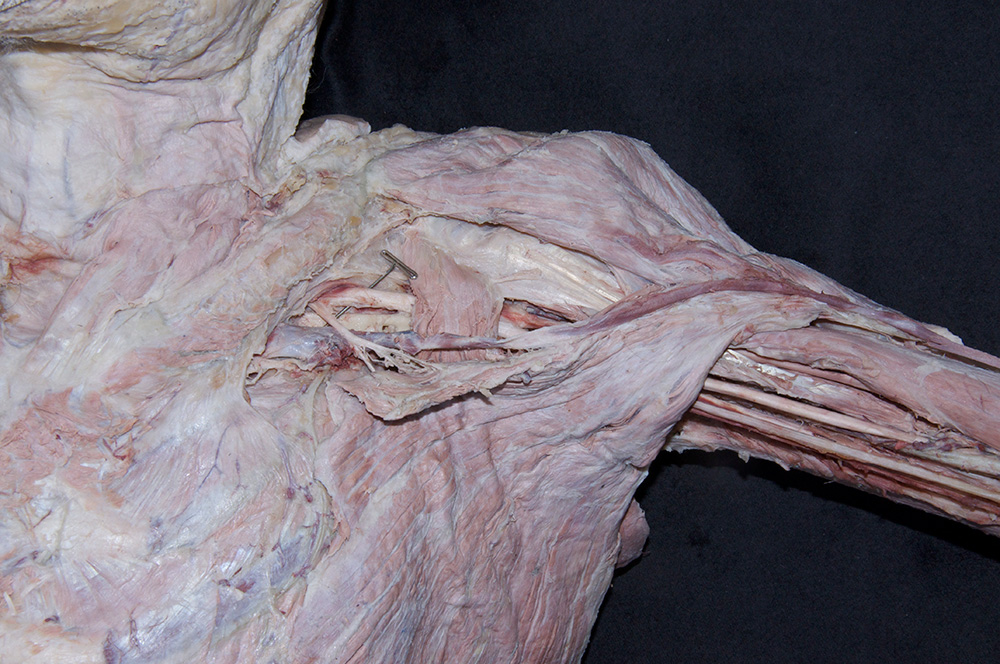 Lateral Cord