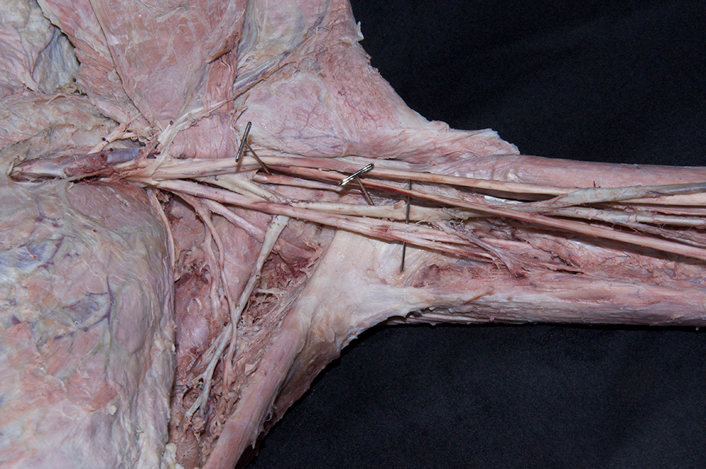 Radial Nerve