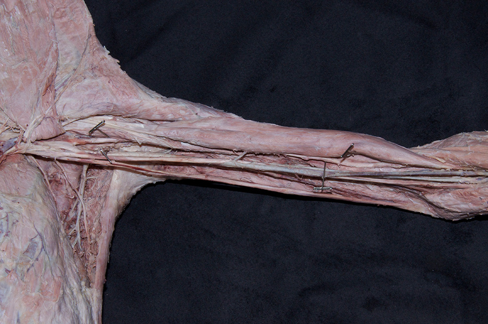 Musculocutaneous Nerve