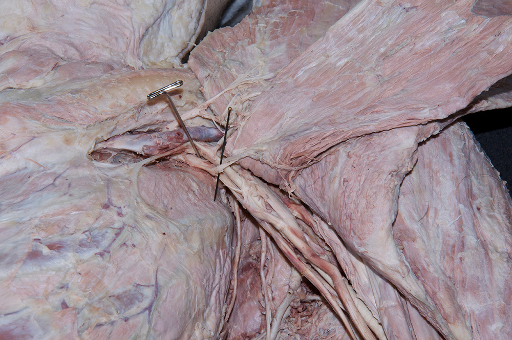 Medial Pectoral Nerve