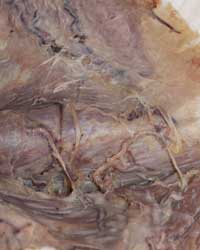 Reflected Trapezius
