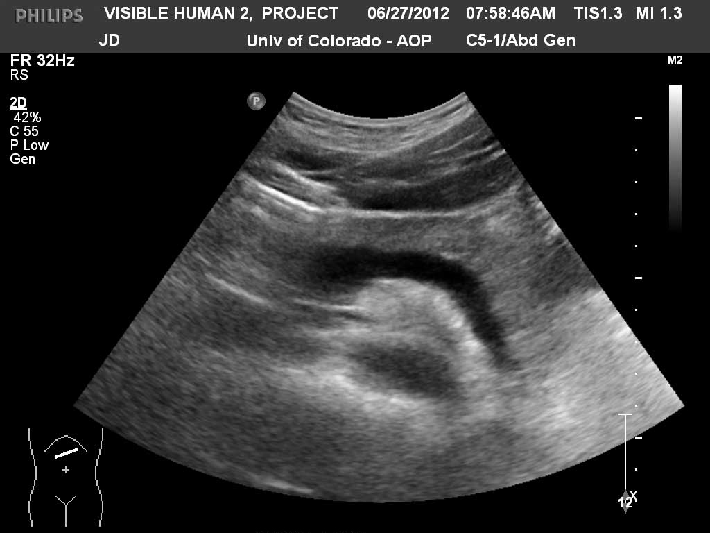 pancreas ultrasound