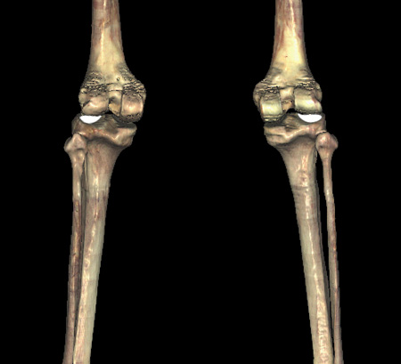 13: Bones and Bony Landmarks of the Lower Limb