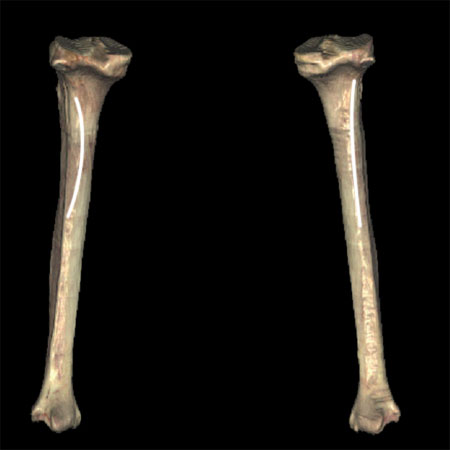 13: Bones and Bony Landmarks of the Lower Limb