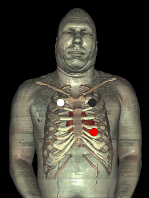 3 Lead EKG Placement