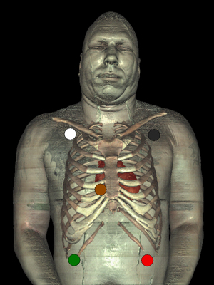 5 Lead EKG Placement