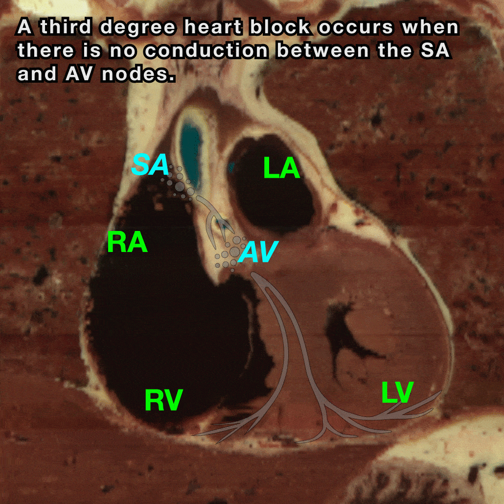 Third Degree Block