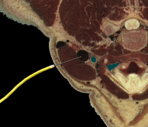 PAC - Internal Jugular Vein Insertion