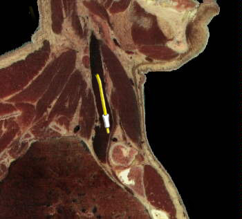 PAC - Internal Jugular Vein
