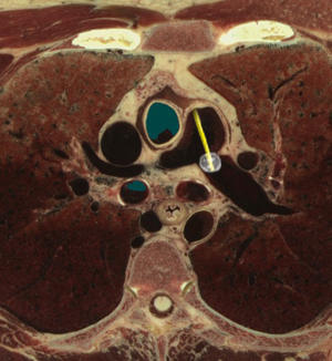 PAC - Pulmonary Artery Cross-Section