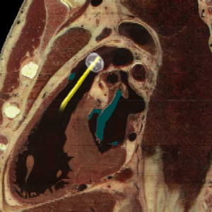 PAC - Pulmonary Artery