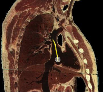 PAC - Right Atrium