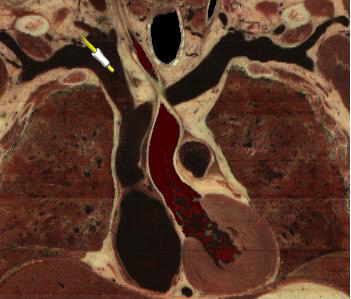 PAC - Subclavian Vein