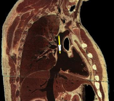 PAC - Superior Vena Cava