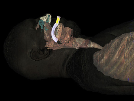 Oropharyngeal Airway