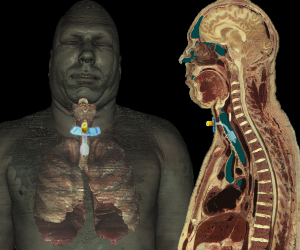 Tracheostomy