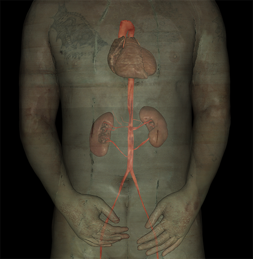 Abdominal Vascular Auscultation